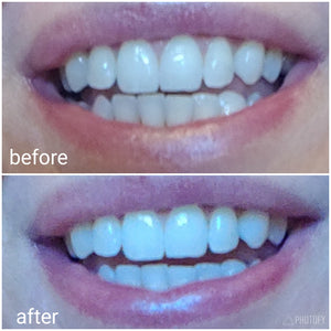 Truewhite Advanced LED Light Teeth Whitening System