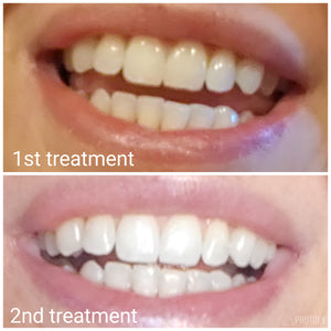 Truewhite Advanced LED Light Teeth Whitening System